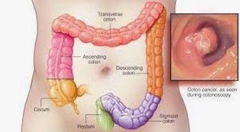 imagen IL-6 contra el cancer de colon noticia apeced